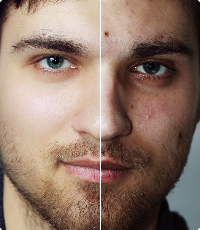 Microneedling before and after results
