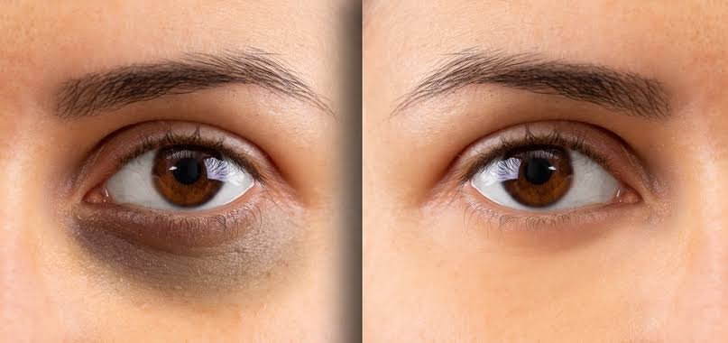 Under-Eye Dark Circles and Hollows Treatment