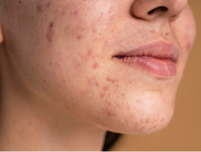 Close-up of a person experiencing active acne