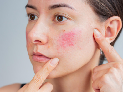 Laser hair removal treatment