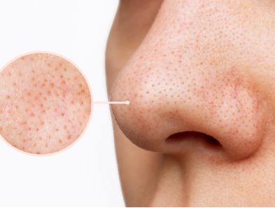 Laser hair removal treatment