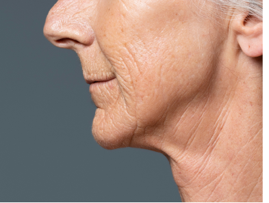 Laser hair removal treatment