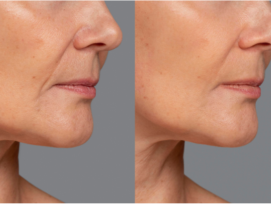 Laser hair removal treatment
