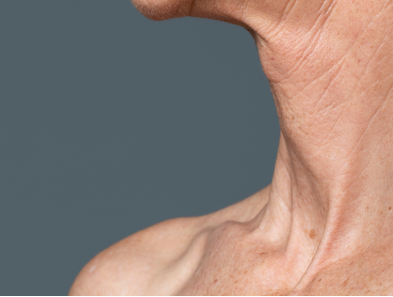 Laser hair removal treatment