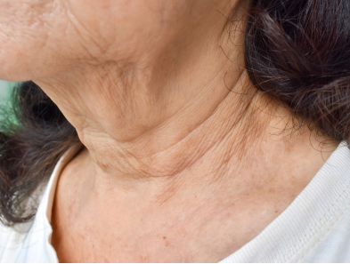 Laser hair removal treatment