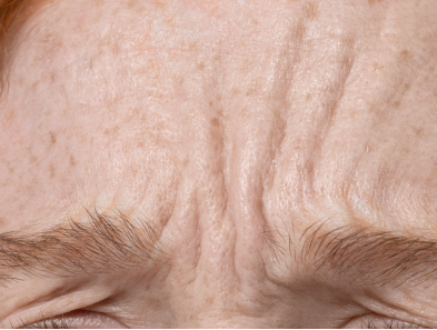 Laser hair removal treatment