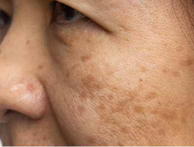 Laser hair removal treatment