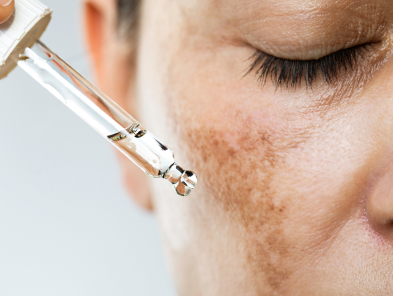 Laser hair removal treatment