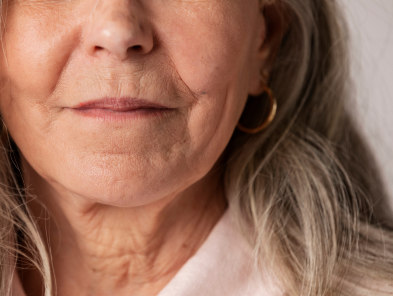 Laser hair removal treatment