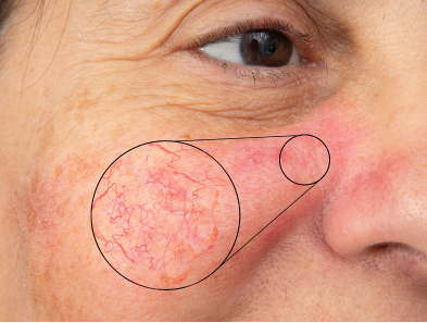 Laser hair removal treatment