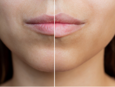 Close-up comparison of the lips and lower face